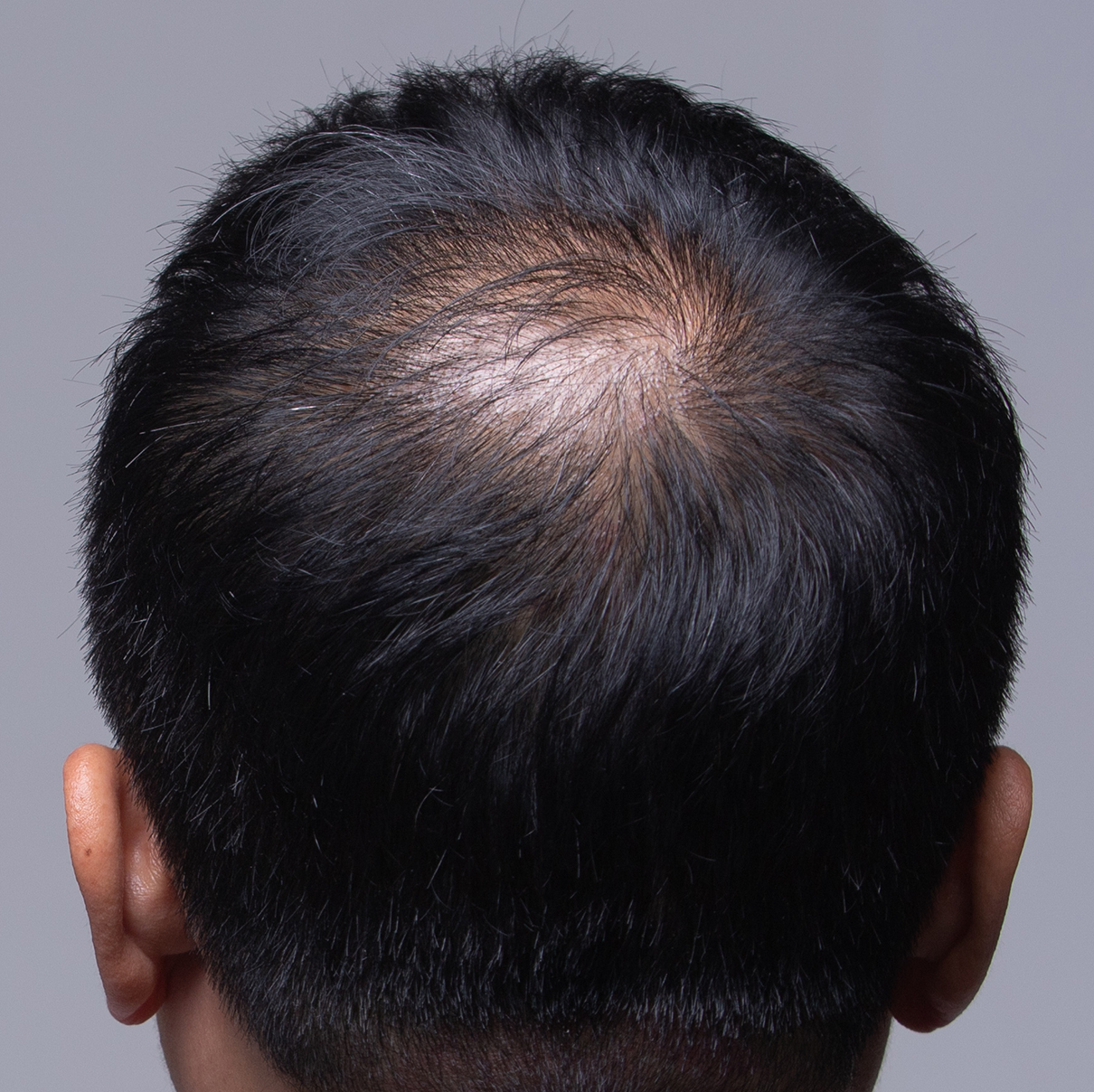 hair_loss