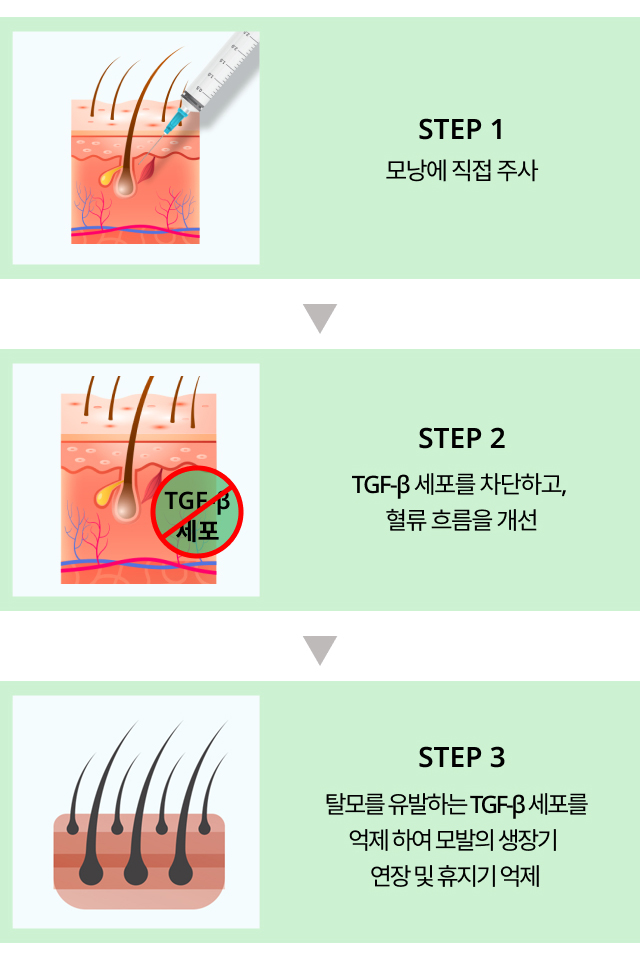 탈모치료